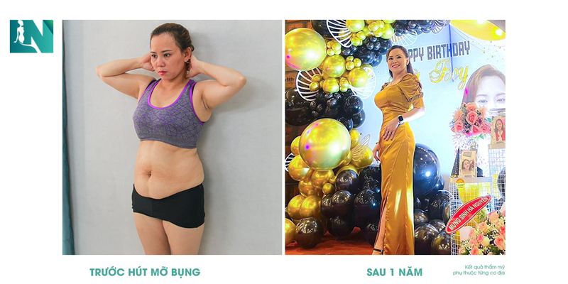 Hình sau hút mỡ bụng 2 ngày