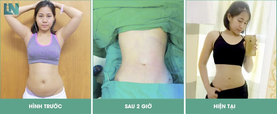 Hình sau hút mỡ bụng 2 giờ