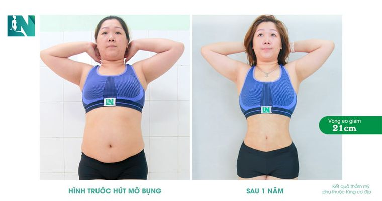 Hình trước hút mỡ tay lưng