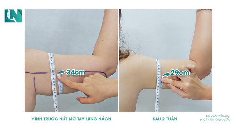 Hình trước hút mỡ bụng